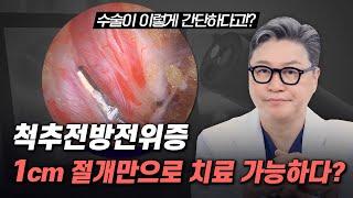 척추전방전위증, 1cm 절개만으로 치료 가능하다? | 척추 MRI 소견 | 참포도나무병원 이동엽 원장