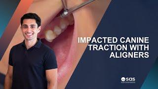 Impacted canine traction with aligners | Dr. Luis González