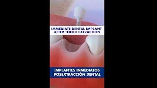 This is how an IMMEDIATE IMPLANT is placed after tooth EXTRACTION