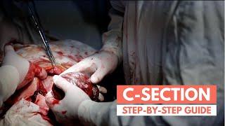 What to expect during a C-section | Real Footage