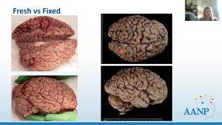 AANP Teaching Rounds - April 24, 2024 - An Introduction to the Brain Autopsy