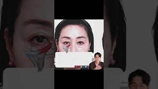 Ep4-3. 리프팅공부하기 대구눈밑지방재배치 / 겉에 보이는 흉터 없이 대박나는 분들과 절개가 필요한 분들에 대해 알아보자 #대구눈밑지방재배치#눈밑지 #대구성형외과
