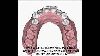 D1 Dental 디원치과 아미절라인 AMIsalign 투명교정 박*연 님 케이스리포트