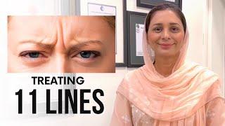 Treating 11 Lines/Frown Lines