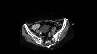 Low-Grade Appendiceal Mucinous Neoplasm