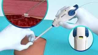 MANTA Vascular Closure Device Animation