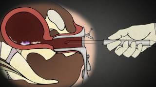 First trimester surgical Abortion