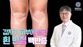 백반증이 생기는 이유와 치료법