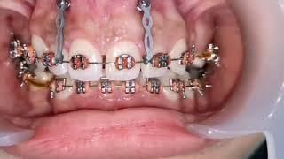 Gummy smile treatment with mini implant, upper incisors intrusion with orthodontic mini screw