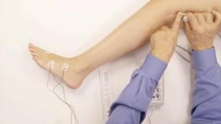 PERONEAL MOTOR WITH F-WAVE