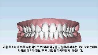 D1 Dental 디원치과 아미절라인 AMIsalign 투명교정 조*경 님 케이스리포트