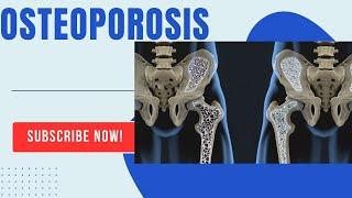 Osteoporosis