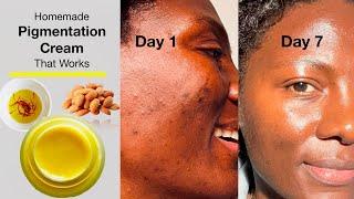 Homemade Hyperpigmentation / Dark Spot /Age Spot / Face Cream That Works (Dark Spots Gone In 7 Days)