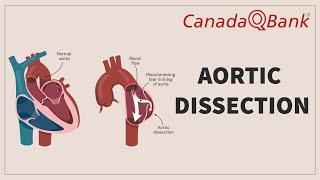 Aortic Dissection: Causes, Symptoms, Diagnosis & Treatment | Clinical Cases | CanadaQBank