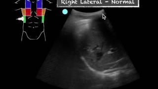 POCUS - Teaching Point - Ultrasound vs CXR in pneumonia