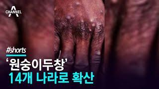 ‘원숭이두창’ 14개 나라로 확산 / 채널A #shorts