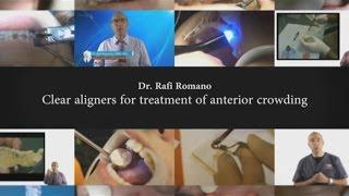 Dr. Rafi Romano - Clear aligners for treatment of anterior crowding