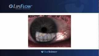 Lipiflow - Dry Eye Therapy at the Gavin Herbert Eye Institute, UC Irvine