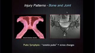 Imaging of Groin Pain: Athletic Pubalgia