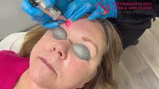 Laser Tattoo Removal on Eyebrows | Dr. Shalini Gupta