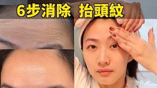0成本去抬頭紋 3方面攻破頑固額頭紋路