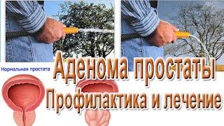 Струйный диагноз – аденома простаты. Чем лечить простатит.