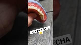 Съемный протез БЕЗ нёба. #съёмныезубныепротезы #безнёбасъёмныепротезы #зубныепротезы #стоматология