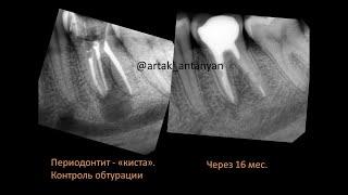 Как заживает «киста» зуба? Удаление кисты зуба. Зуб имплант. Периодонтит. Гайморит. Виниры