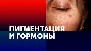 ПИГМЕНТАЦИЯ И ГОРМОНЫ. ТИПЫ ПРОЯВЛЕНИЯ ПЯТЕН НА ЛИЦЕ.