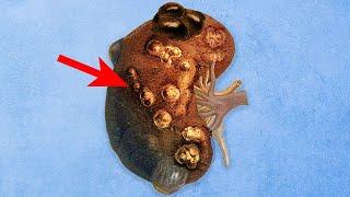 A Man Overdosed Vitamin D. This Is What Happened To His Kidneys.