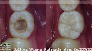 Posterior Endo-Resto Case Management By Aditya Wisnu Putranto
