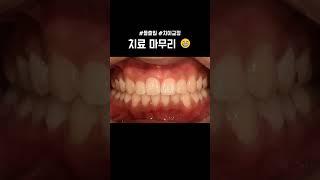 교정하면 생기는 변화 #돌출입 #치아교정
