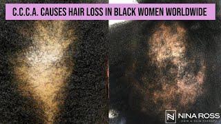 What is CCCA? Central Centrifugal Cicatricial Alopecia is a Common Cause of Hair Loss in Black Women