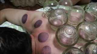 Traditional Chinese Medicine TCM Cupping Schröpfen in China 拔罐子 カッピング療法 Ventosaterapia bekam api