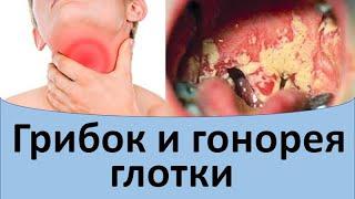 Грибок и гонорея в глотке