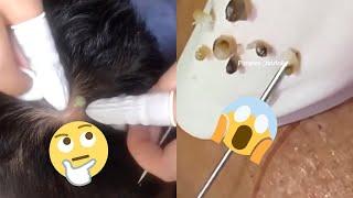 Ultimate Pimple Popping Compilation: Prepare to Be Amazed!