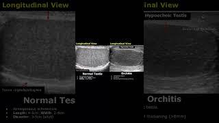 Orchitis Ultrasound Features | Scrotal Scan Normal Vs Abnormal | Testis USG #shorts