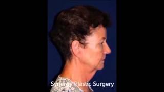 Facial Rejuvenation from Facelift and Neck Lift Surgery with Dr. Kerr