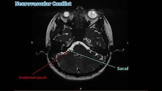 Microvascular Decompression pada Hemifacial Spasme