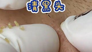 #抠师傅挤黑头 #解压视频 #挤痘痘 #强迫症看了很享受