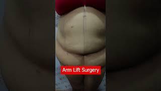 Arm Lift Surgery | Arm Lift Surgery | Arm Lift Surgery cost | BRACHIOPLASTY #Short #shots