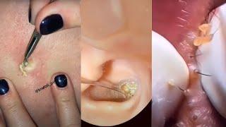 Ultimate Deep Blackhead Extraction: Satisfying Skin Care & Pimple Popping