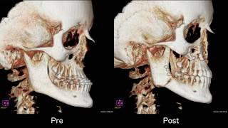 Le Fort I Type Osteotomy and Mandibular Sagittal Osteotomy