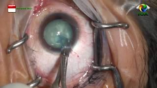 Cataract Surgery (FAST PHACO) 1288