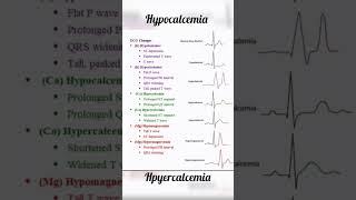 ECG changes - (K , Ca , Mg) ️ ##medical #physiology #shorts @medicoshots