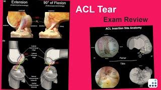 ACL Tear Exam Review - Raymond Kim, MD