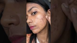 My skin Transformation challenge #shorts  #skintransformation  #pimple #acnetreatment #skincare