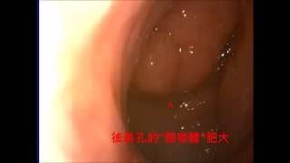 小兒嚴重鼻過敏與腺樣體肥大導致長期鼻塞  pediatric allergic rhintis & adenoid hypertrophy