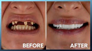 Unbelievable Smile Transformation: a New Yorker at Kristal Clinic