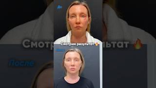 Спейслифтинг 1 неделя после операции #лифтинг #подтяжкалица #омоложение